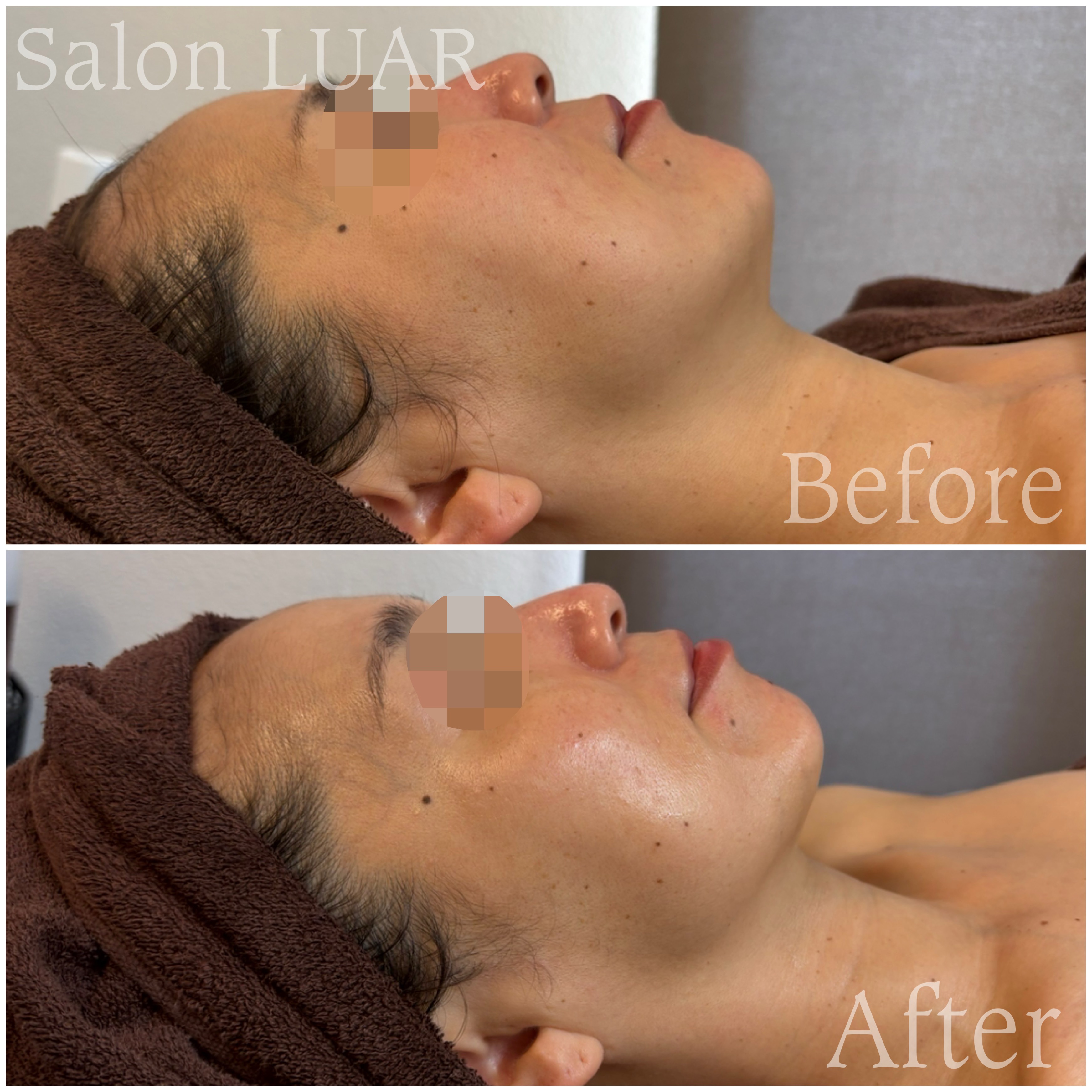 マーメイドセルトリートメント施術例02