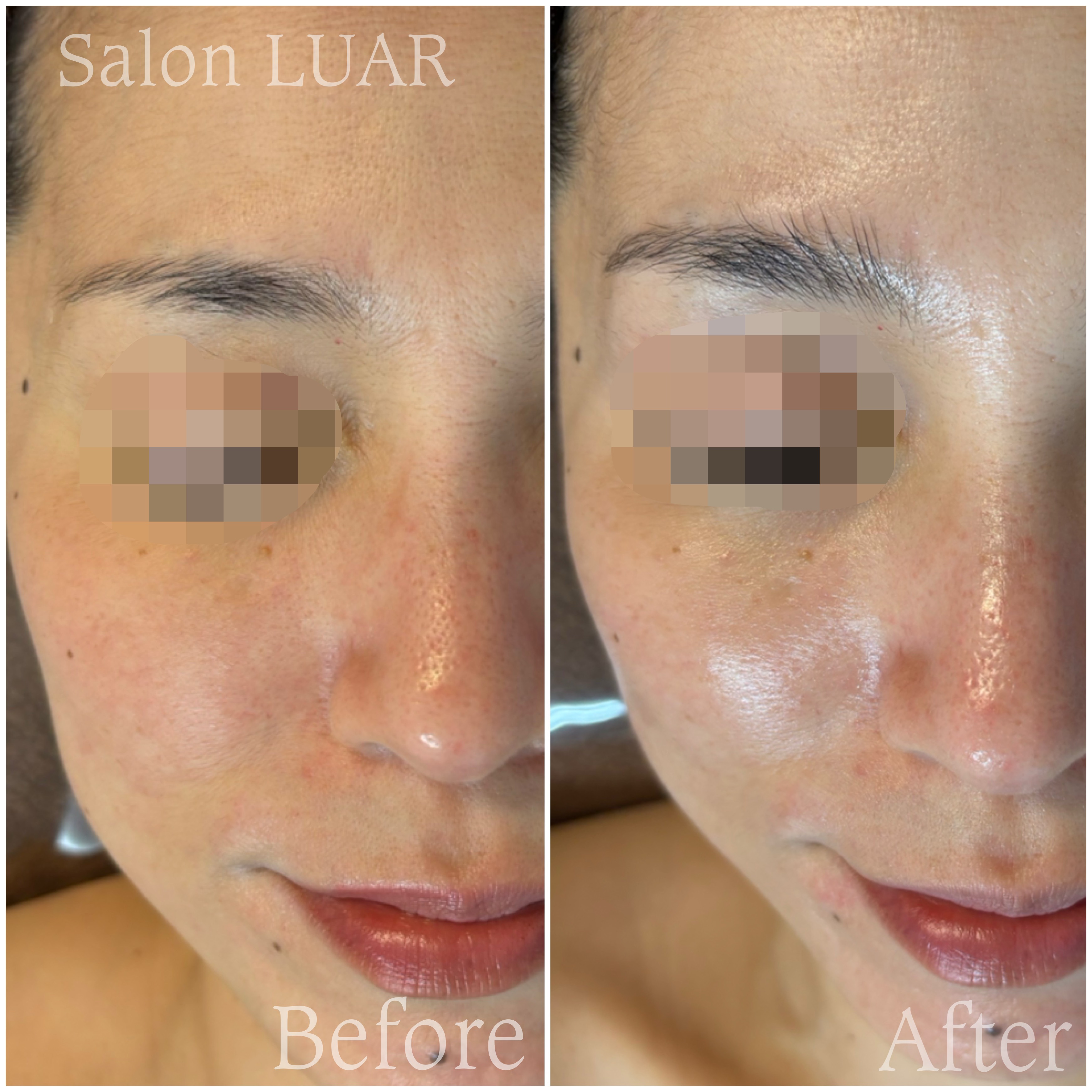 マーメイドセルトリートメント施術例03